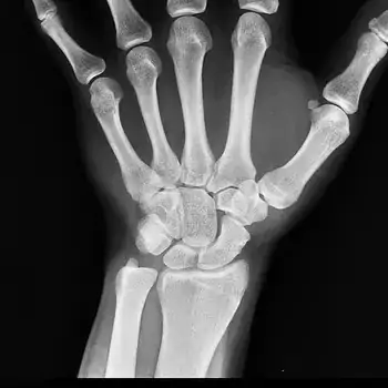 wrist x-ray - Radiography