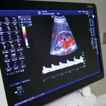 Medical Sonography screen showing an ultrasound image