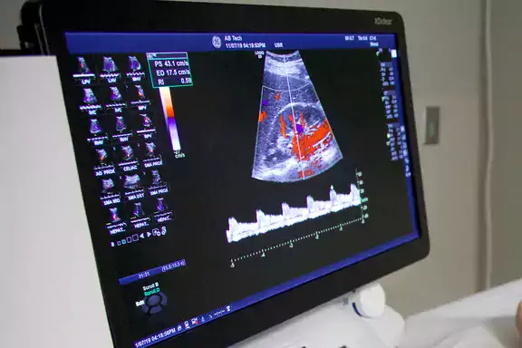 Medical Sonography screen showing an ultrasound image